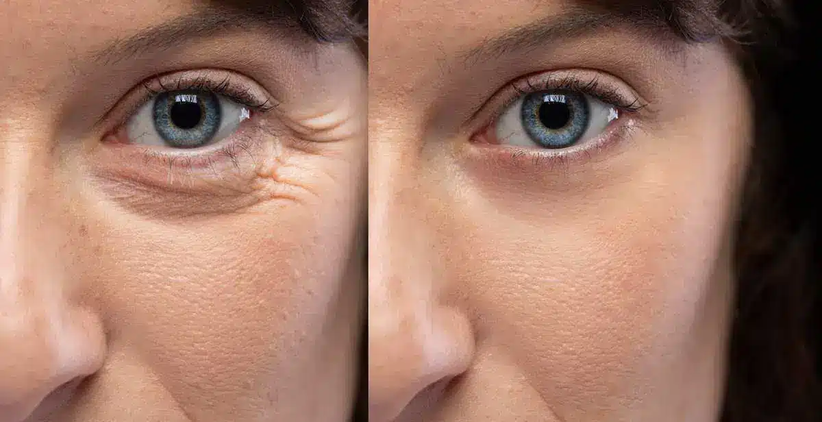 Eye Wrinkles By Samara Medspa in CT