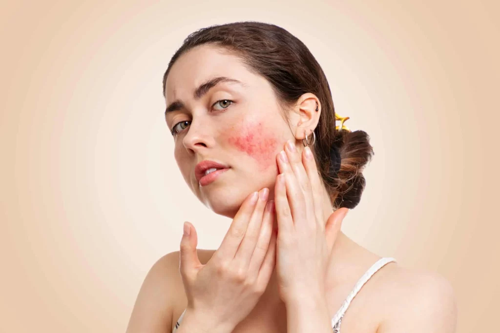 Rosacea Services | Samara Medspa