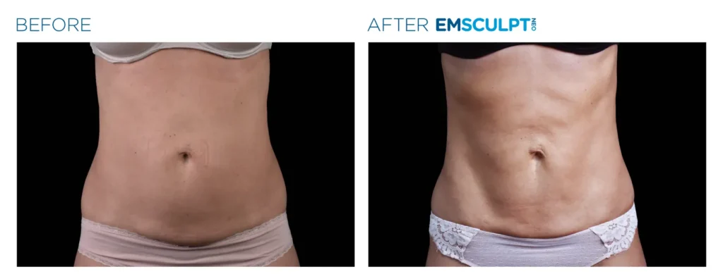 EMSCULPT BA