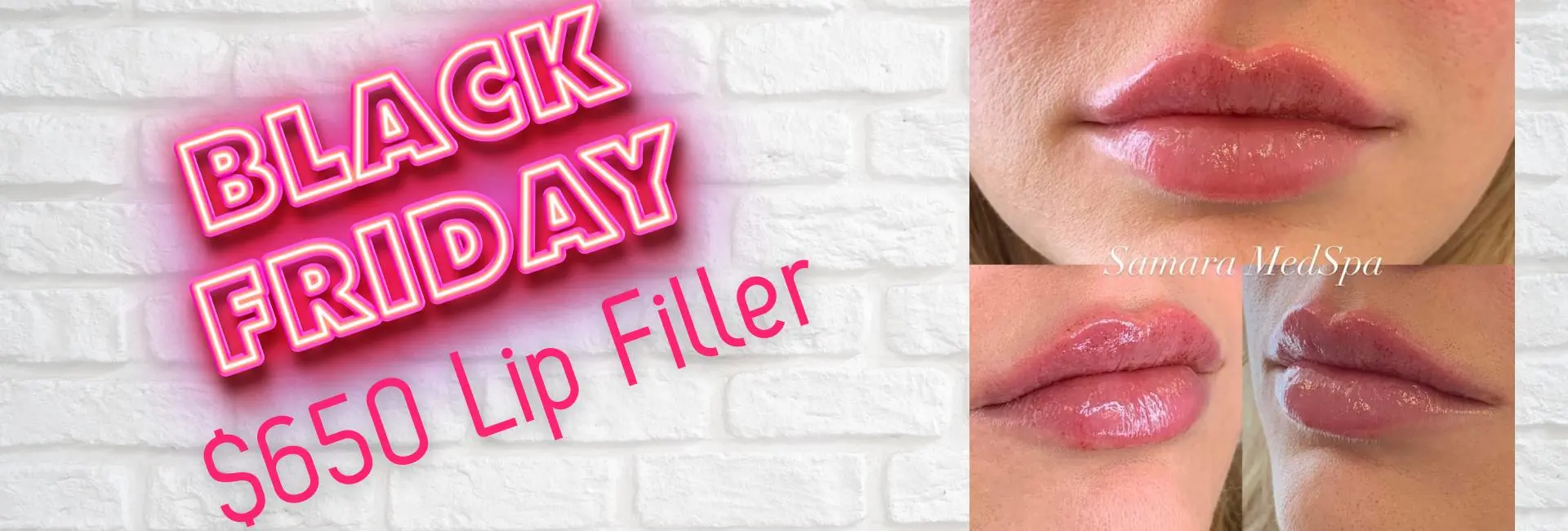 Lip Filler BANNER