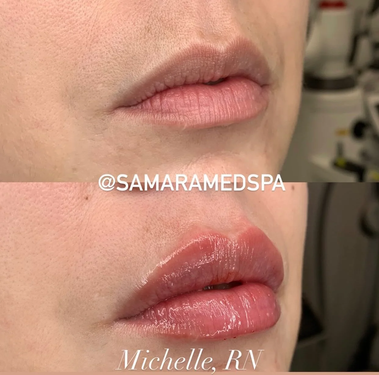 Lip Filler (2)