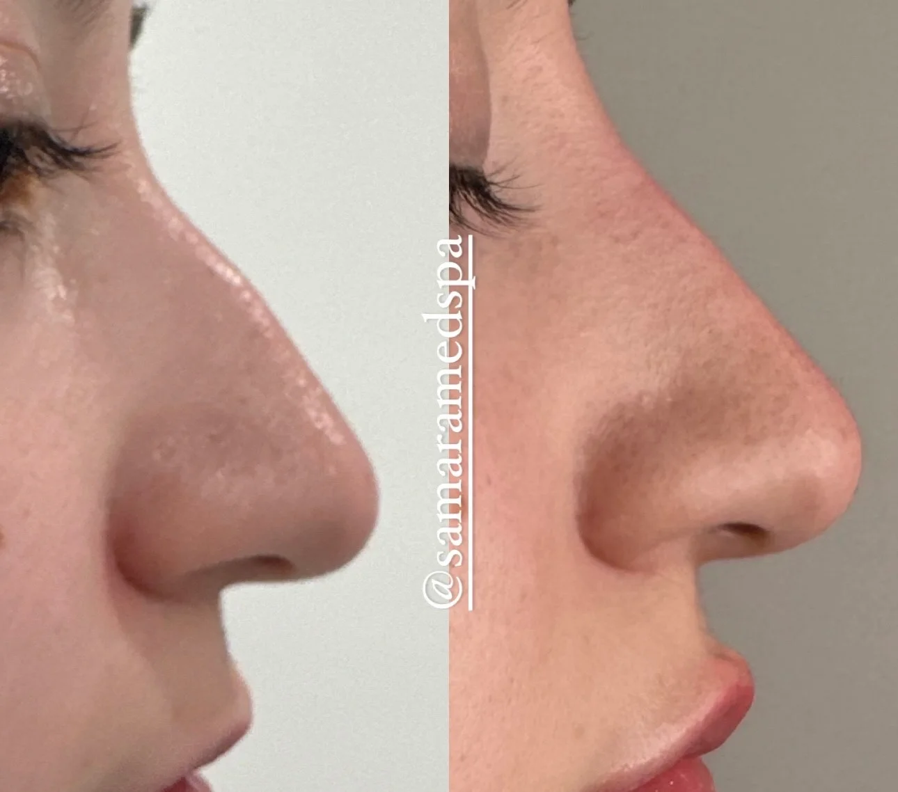 Liquid Rhinoplasty