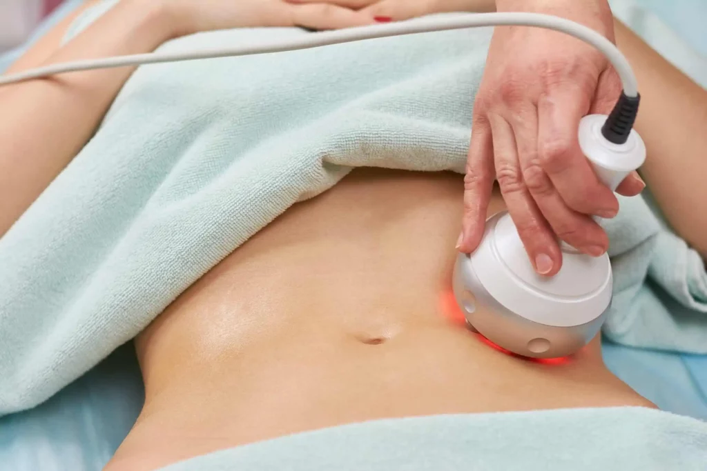 RF BodySculpting in Avon