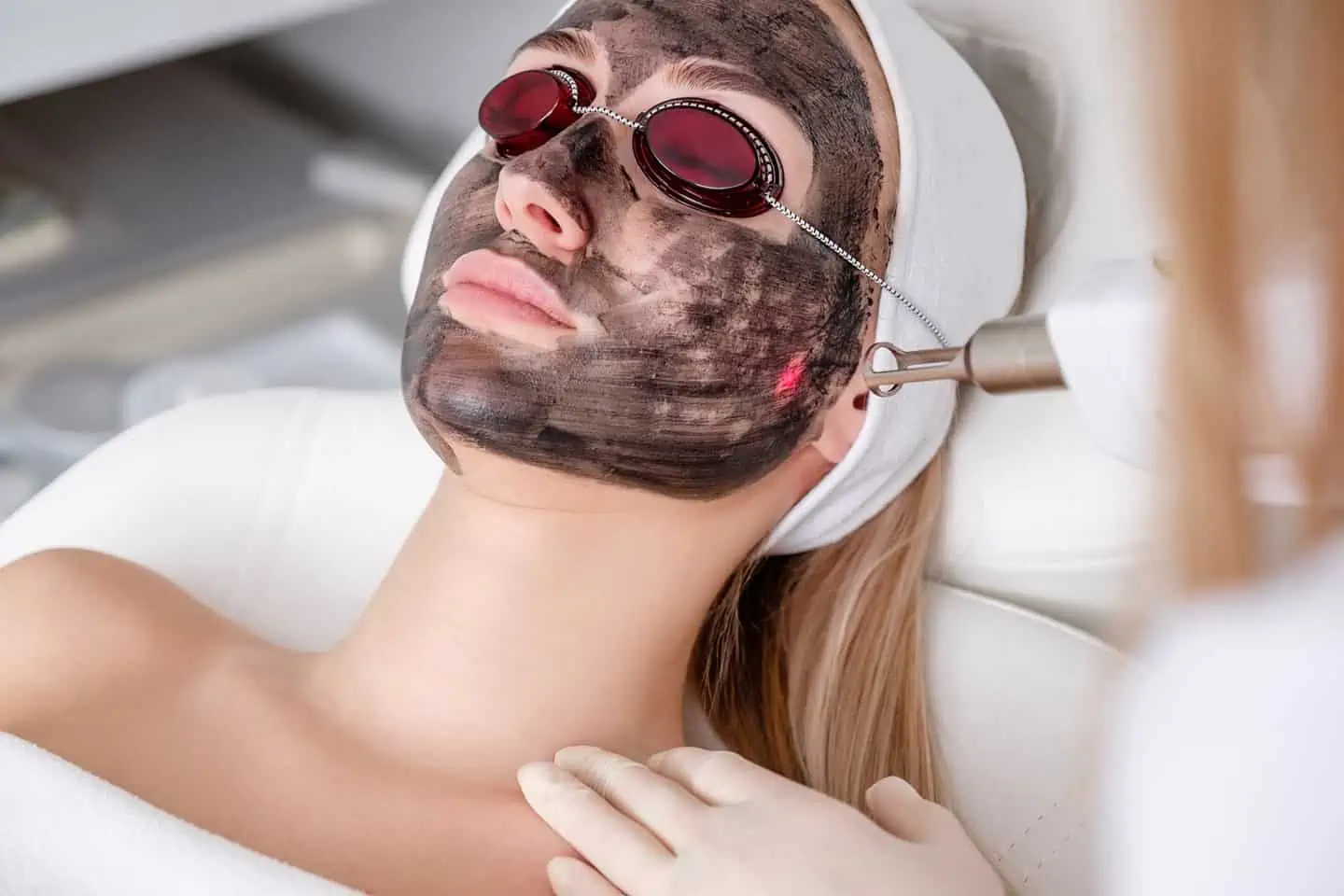 Carbon Laser Facial in Avon