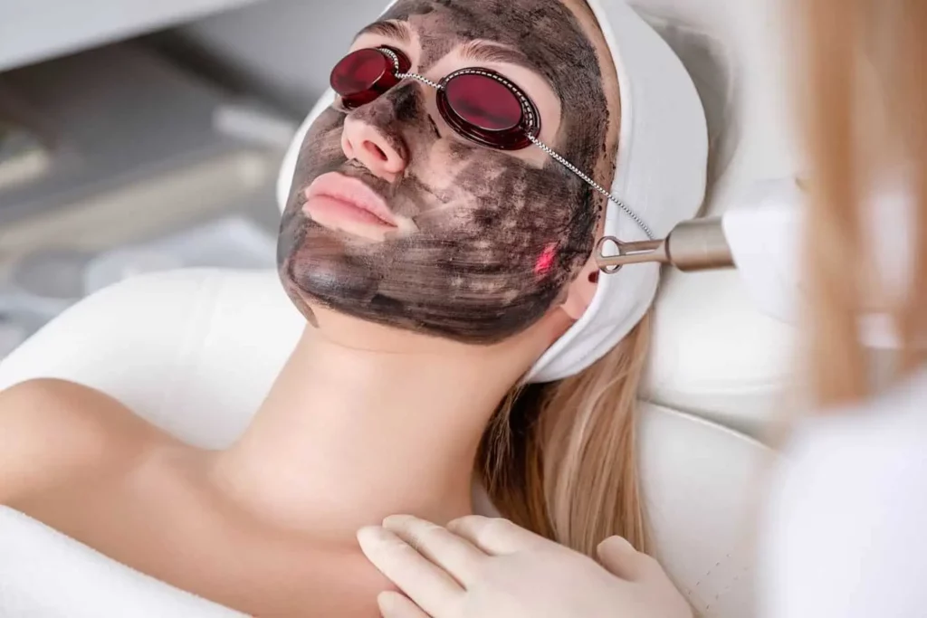 Carbon Laser Facial Services | Samara Medspa