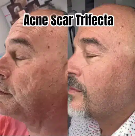 Acne Scar Treatment | Samara Medspa