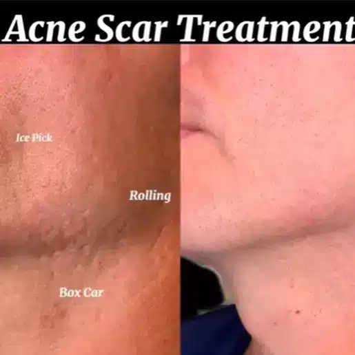 Acne Scar Treatment