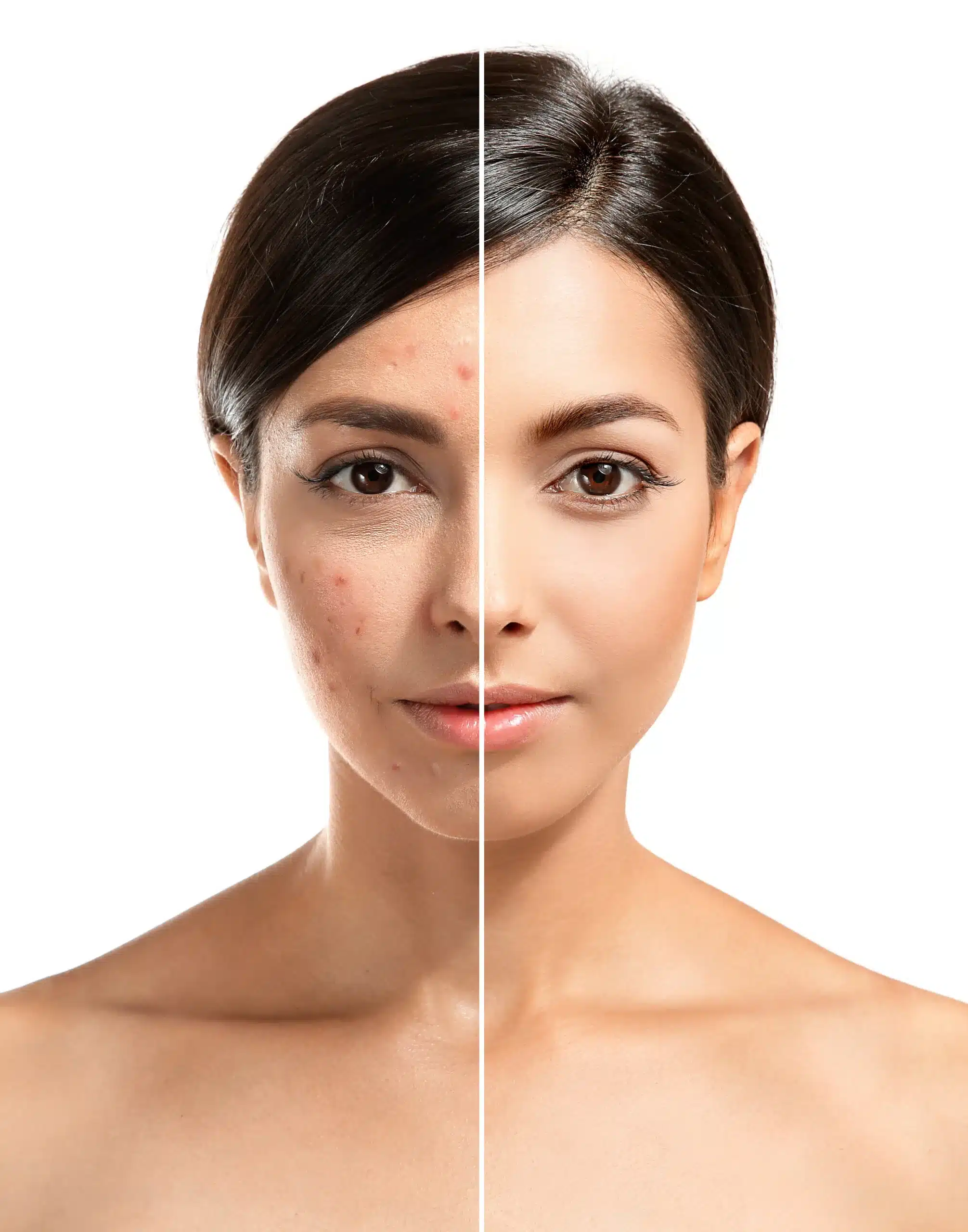 Acne Trifecta Treatment in Avon