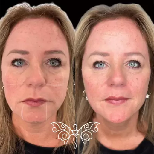 Dermal Fillers Before and After