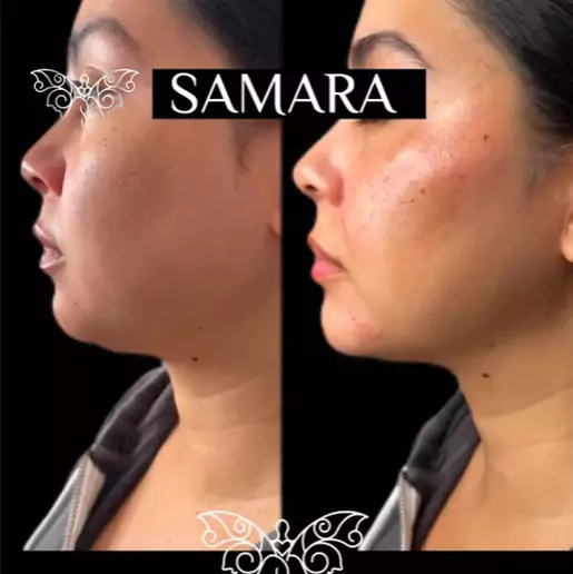 Before and After- Dermal Fillers