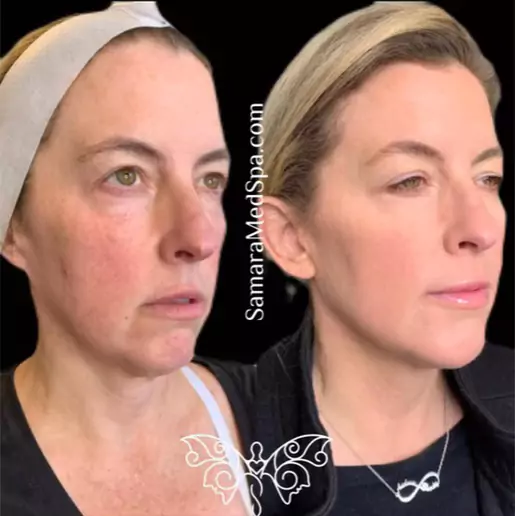 Facial Consonance Before and After