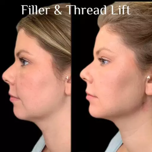 Filler and Thread Lift