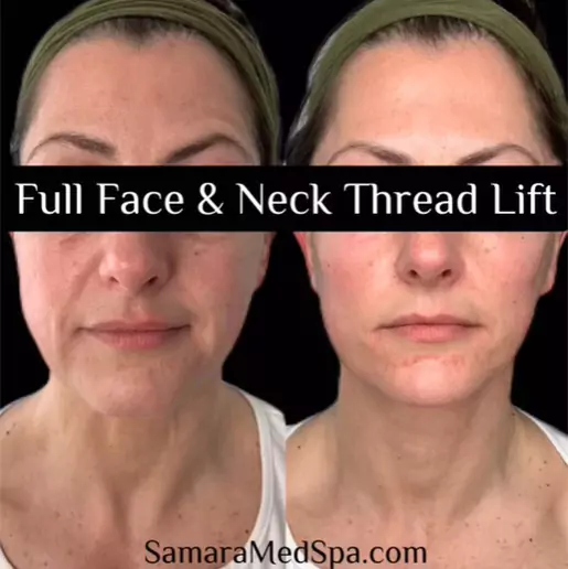 Full Face and Neck Thread Lift