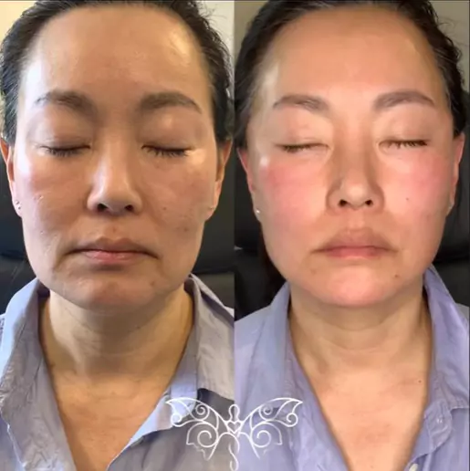Full Face Thread Lift