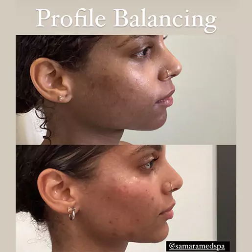 Full Facial Consonance Treatment Before and After