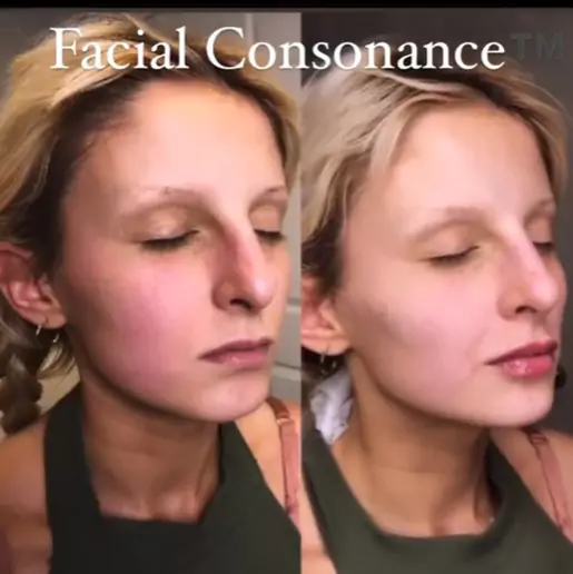 Facial Consonance Before and After