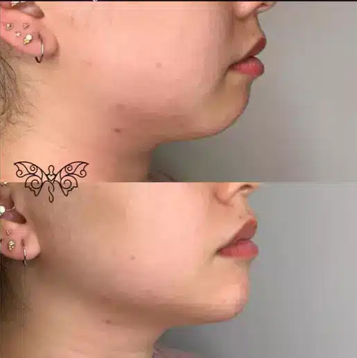 Chin Fillers | Samara Medspa