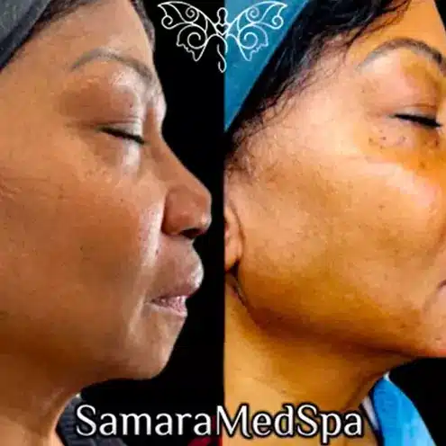 Jawline Thread Lift