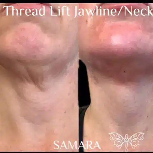 Jawline Thread Lift Neck