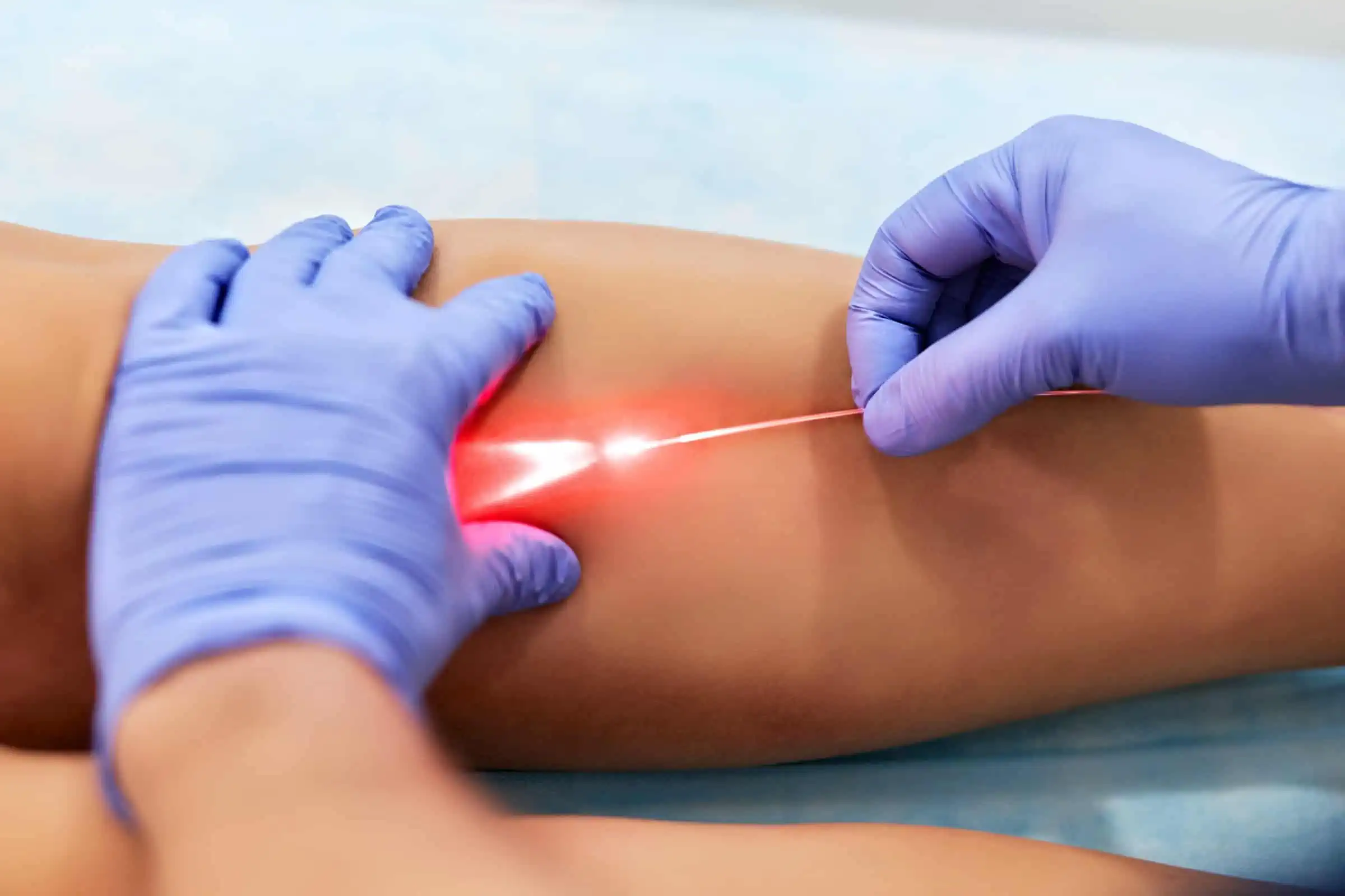 Laser Vein Removal in Avon
