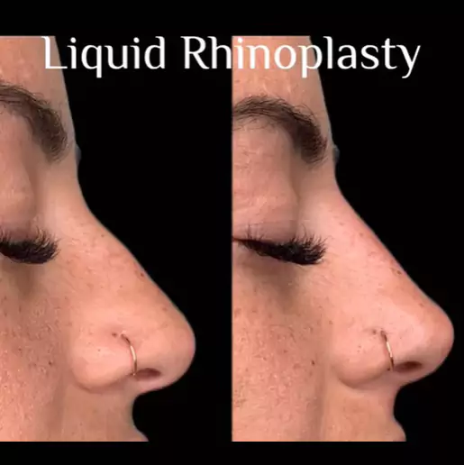Liquid Rhinoplasty