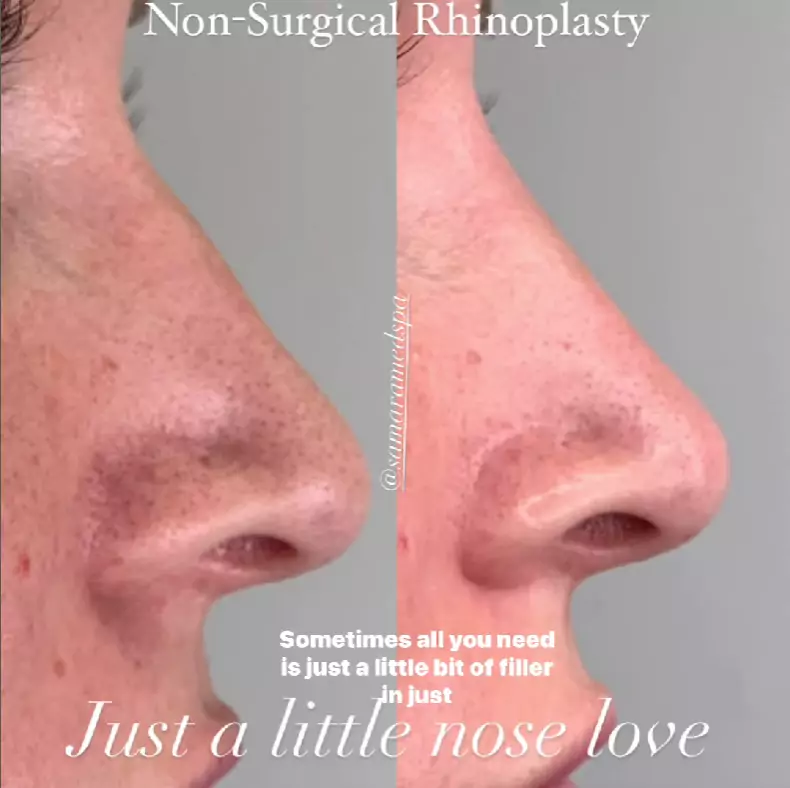 Non-Surgical Rhinoplasty