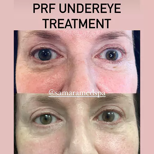PRF Undereye Before and After