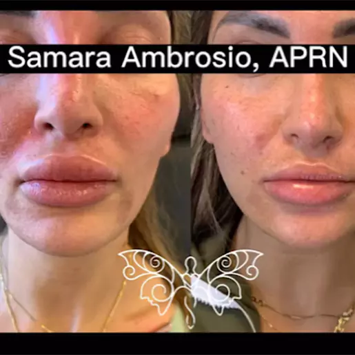 Brigde Technique in Samara Medspa
