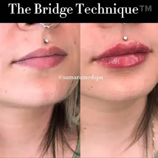 The Brige Technique in Samara Medspa