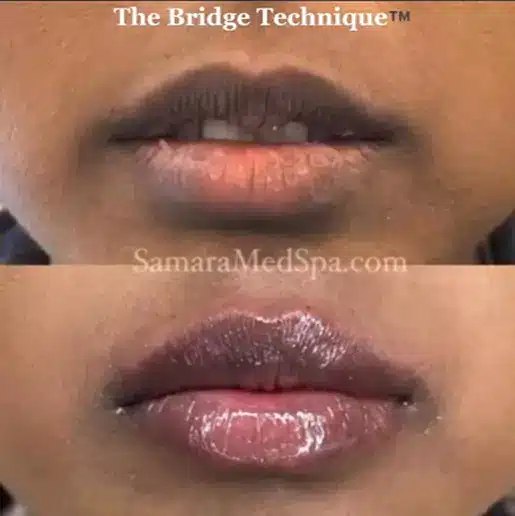 Bridge Technique in Samara