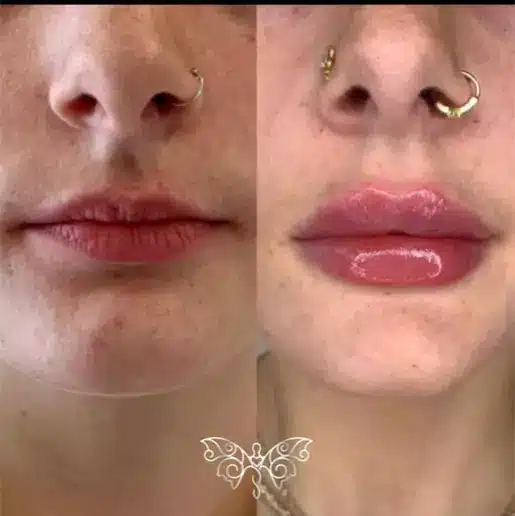 Bridge Technique | Before and After Images