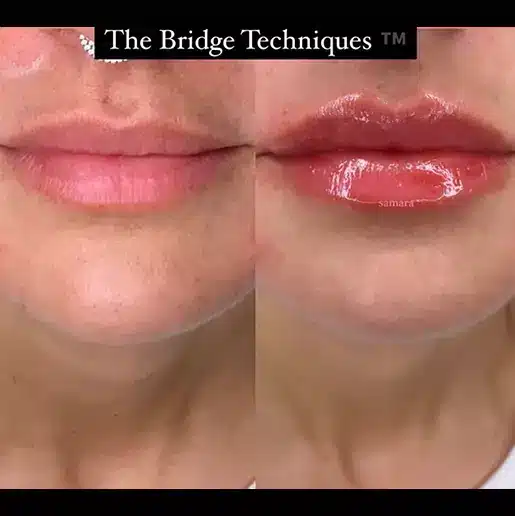 Before and After | Bridge Technique