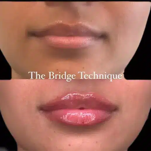 Before and after- Bridge Technique
