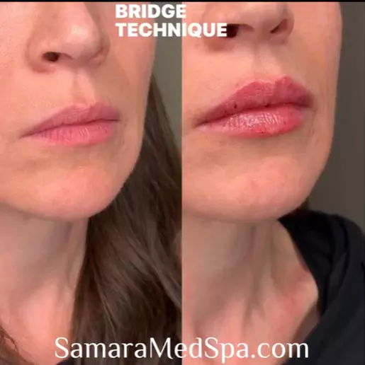 Before & After The Bridge Technique