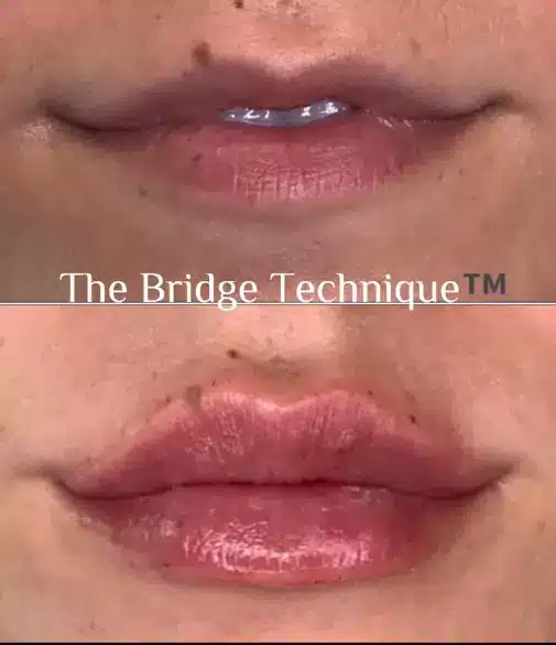 Bridge Technique for Lips
