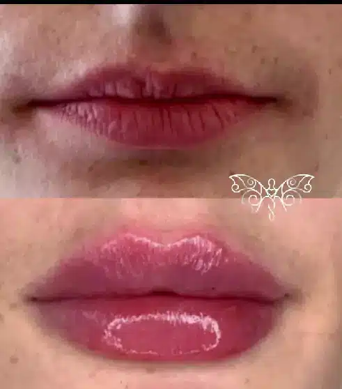 Bridge Technique Treatment
