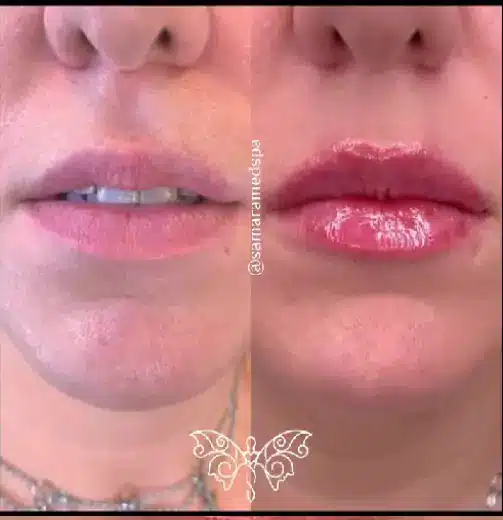 Before and After the Bridge Technique Treatment