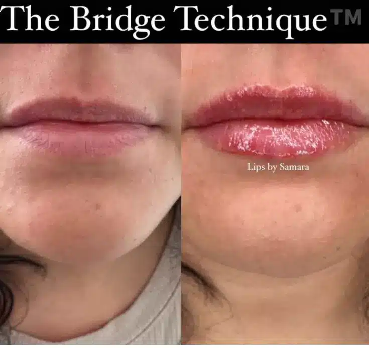 The Bridge Technique Samara Medspa