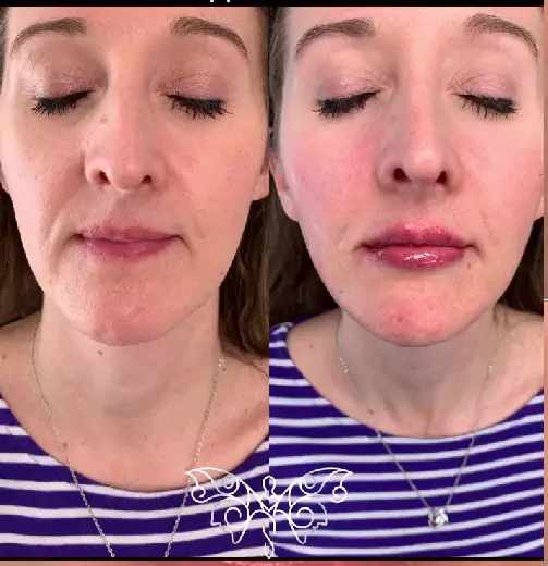 Thread Lift and Filler | Samara Medspa