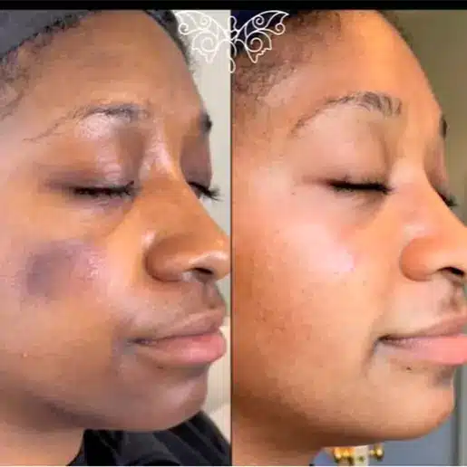 Treat Hyperpigmentation | Before and After