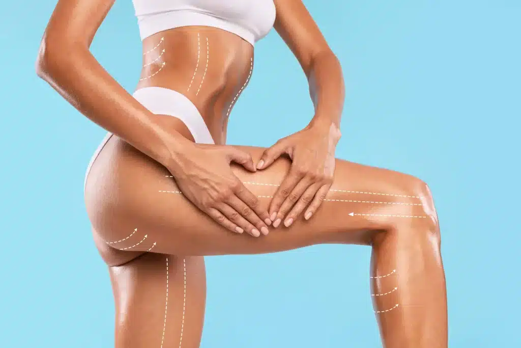 RF Body Skin Tightening
