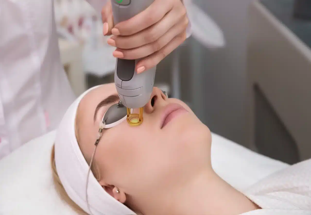 4D Laser Face Lift (Fotona 4D)