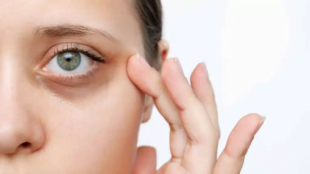Dark Circle Service | Samara Medspa