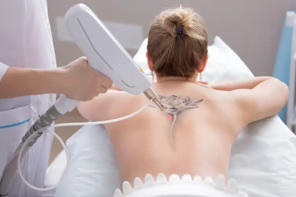Laser Tattoo Removal | Samara Medspa