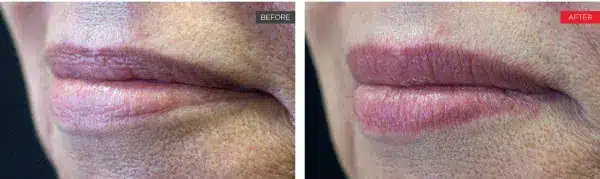 Liplase before after
