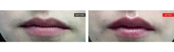 Liplase Before and After