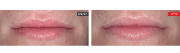 Liplase Before and After