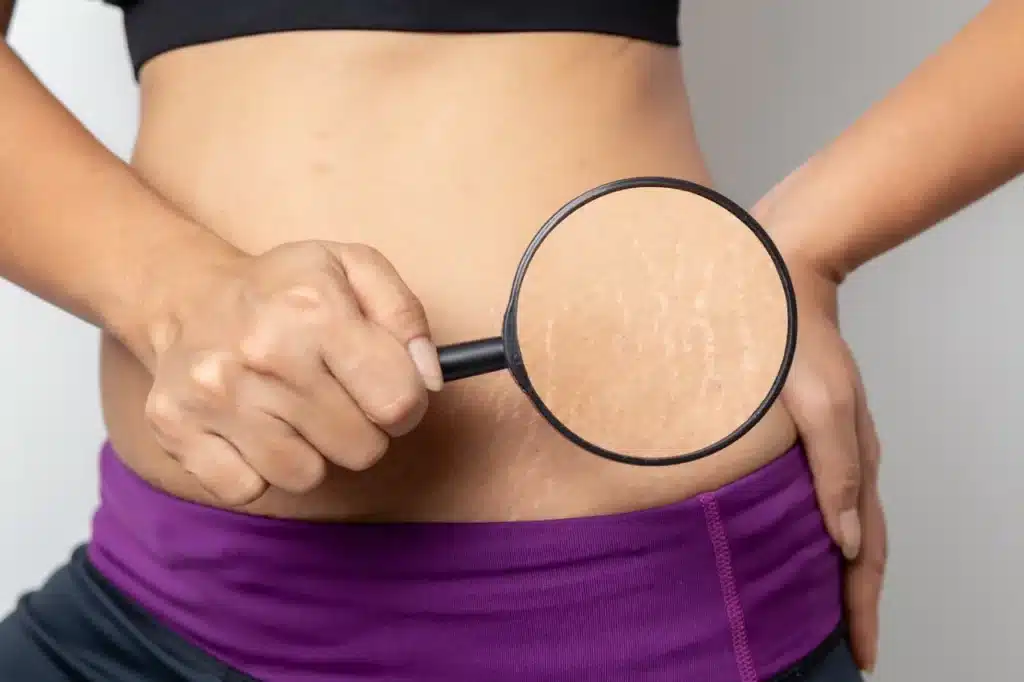 Stretch Marks