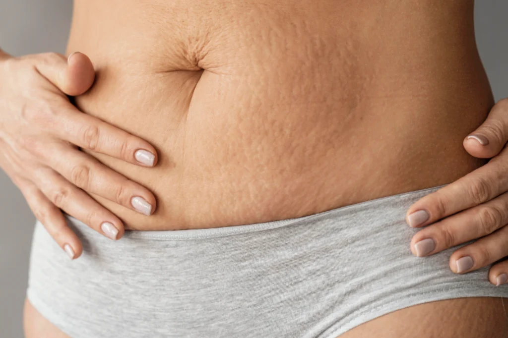 stretch-marks pic