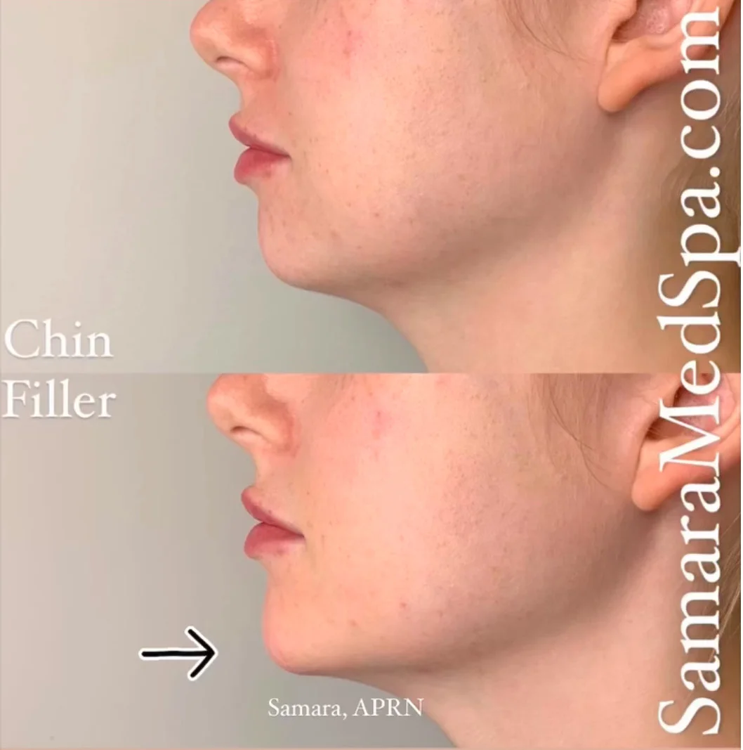 Before and After Chin Filler